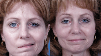 Akupunkturla yüz felci tedavisi