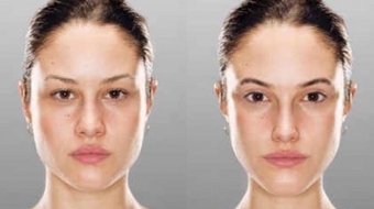 Masseter-Botoxu izmir