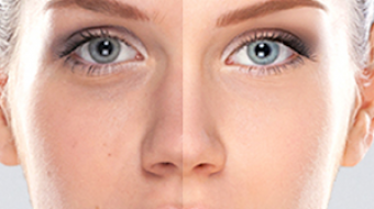 DERMAPEN TEDAVİSİ izmir