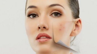 İzmir Akne Tedavisi