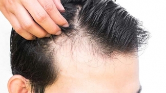 İzmir Saç Dökülme Tedavisi