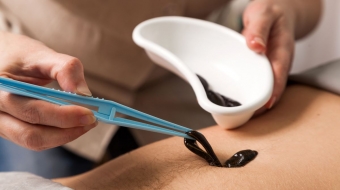 İzmir Sülük Tedavisi