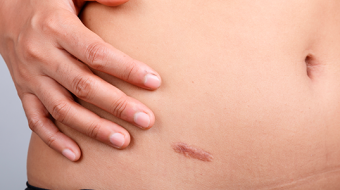 Yara ve Yanık İzi Tedavisi